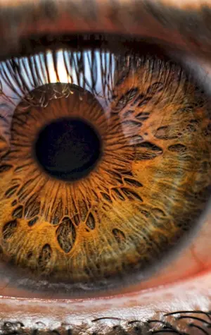 Центральная гетерохромия карих глаз